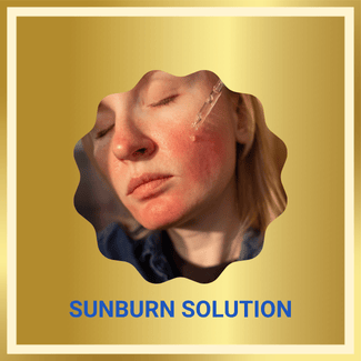 sunburn solution